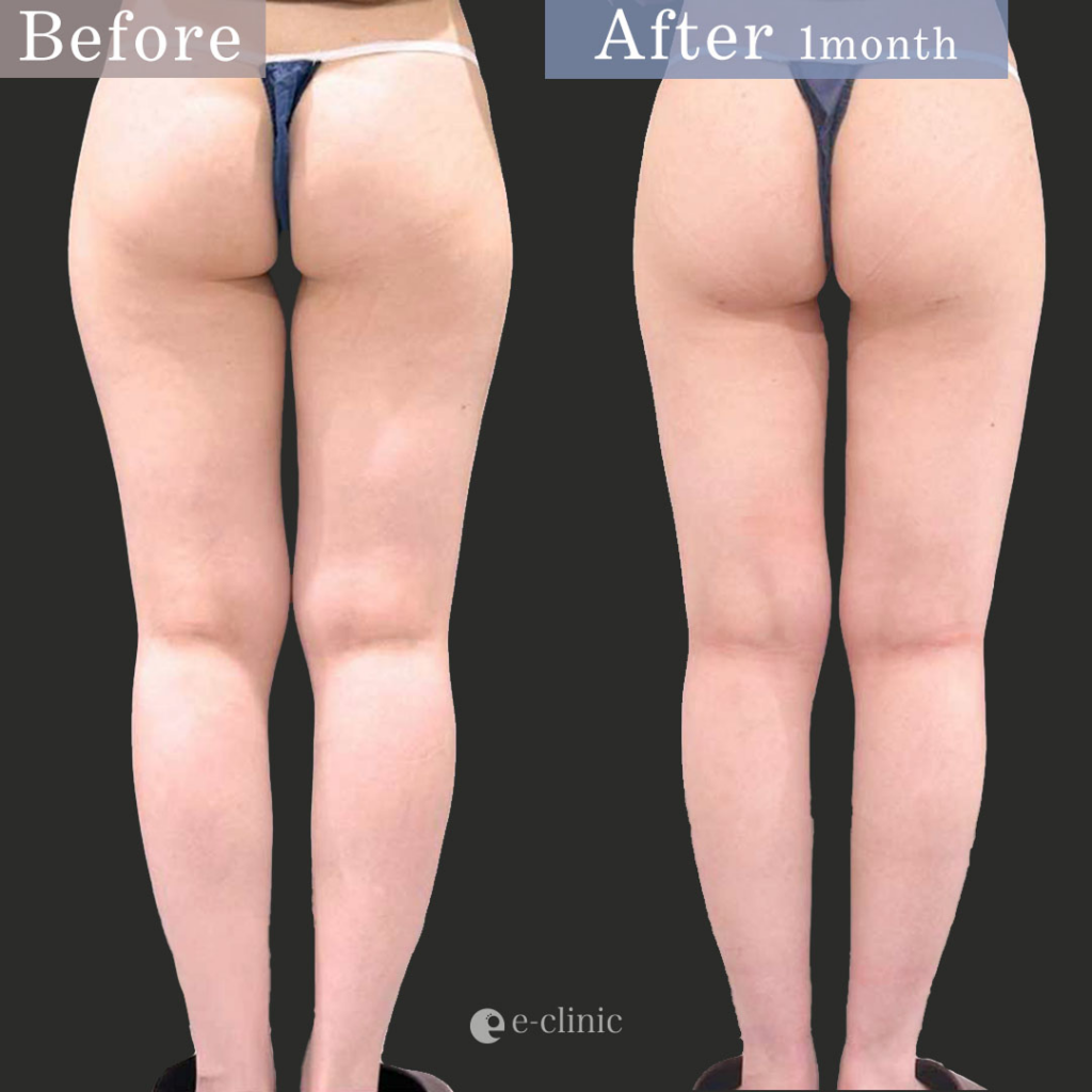 Ultra-Z併用した大腿全周脂肪吸引の症例写真 (1)