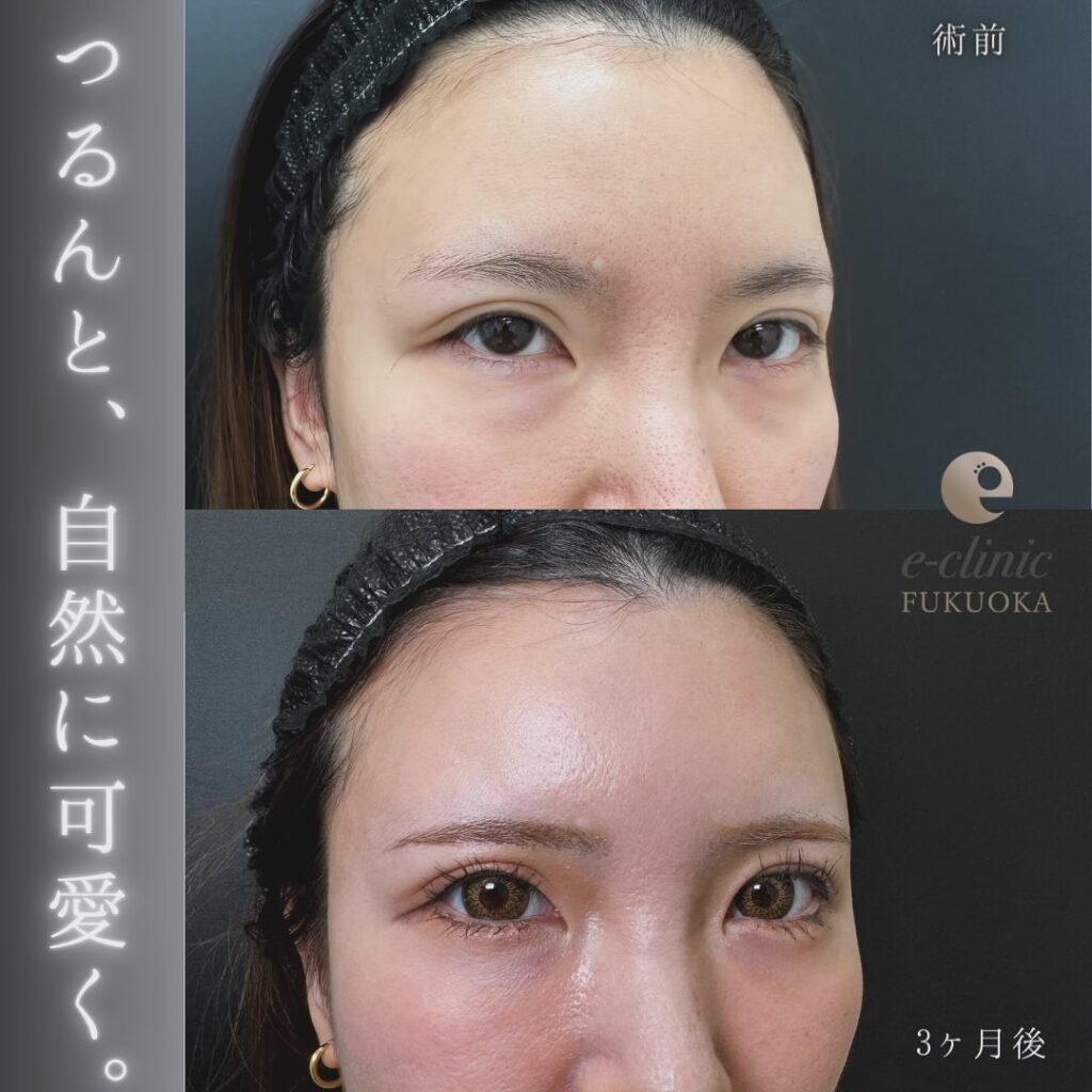 裏ハムラ法とナノリッチの症例写真 (3)