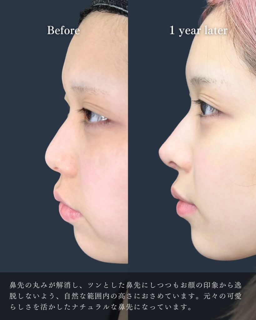 鼻尖形成と軟骨移植と小鼻縮小の症例写真 (8)