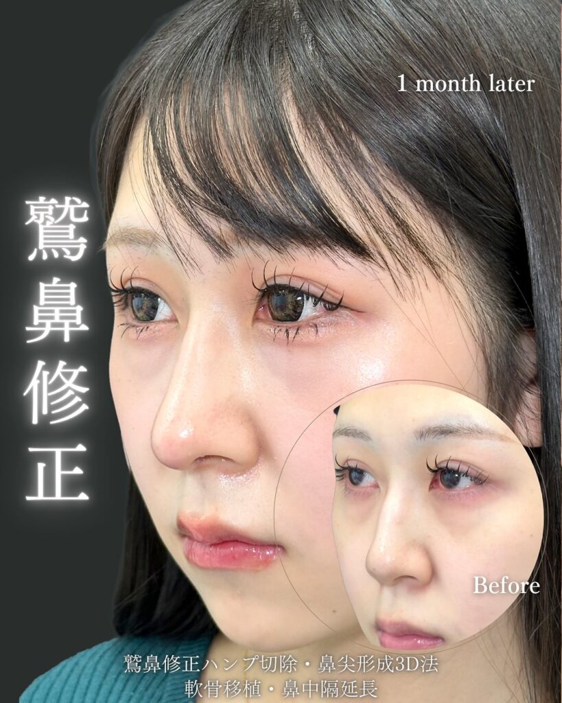 鷲鼻修正と軟骨移植と鼻尖形成と鼻中隔延長の症例写真 (4)