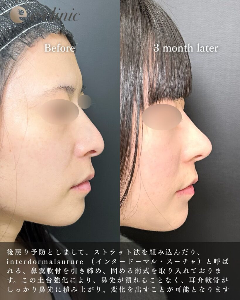 鼻尖形成と耳介軟骨移植の症例写真 (7)