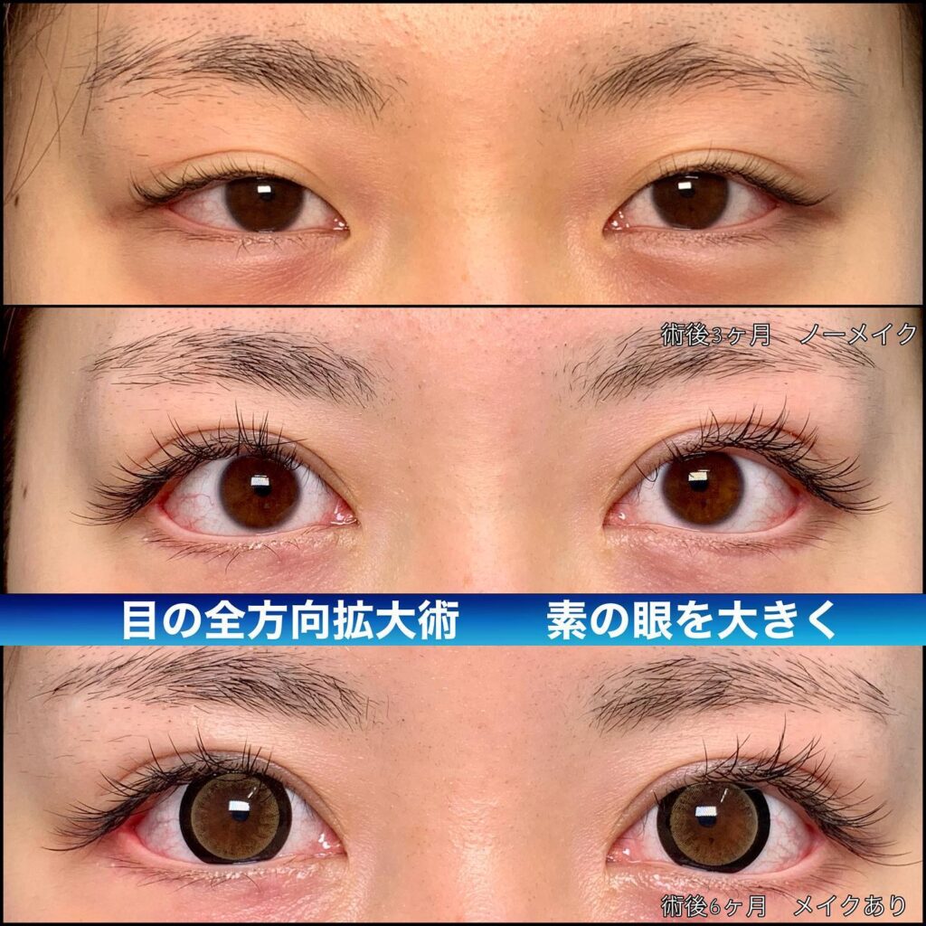 眼瞼下垂と目尻切開と目頭切開の症例写真