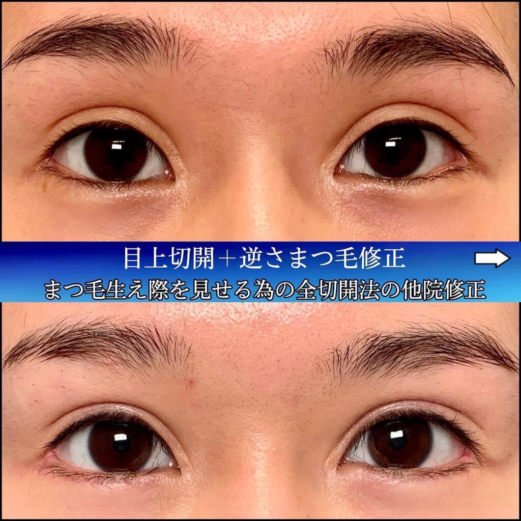 全切開の他院修正 (1)