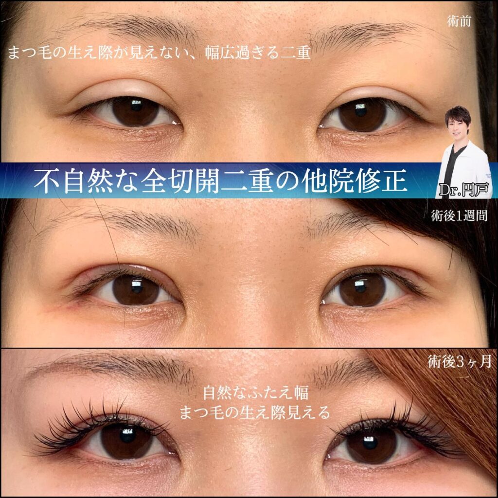 目元の他院修正 (2)