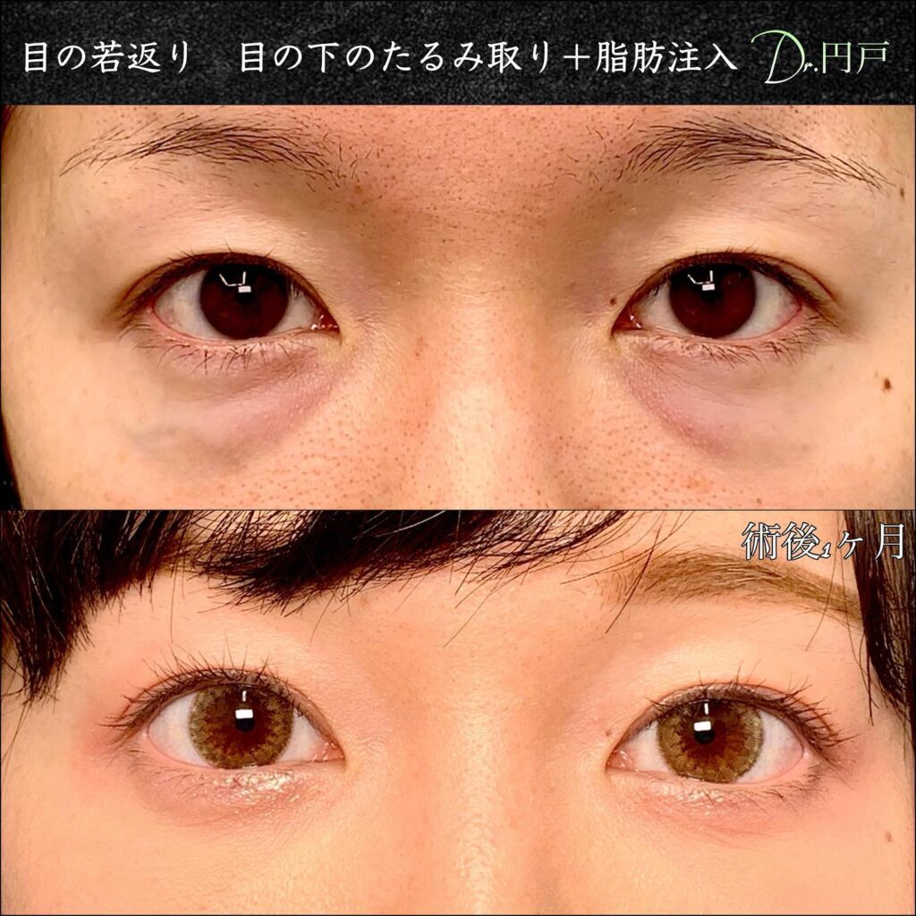 目の下のたるみ取りと脂肪注入