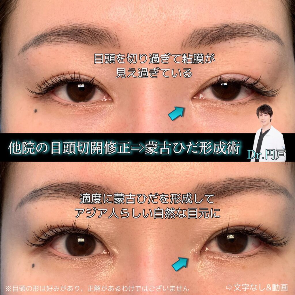 目元の他院修正