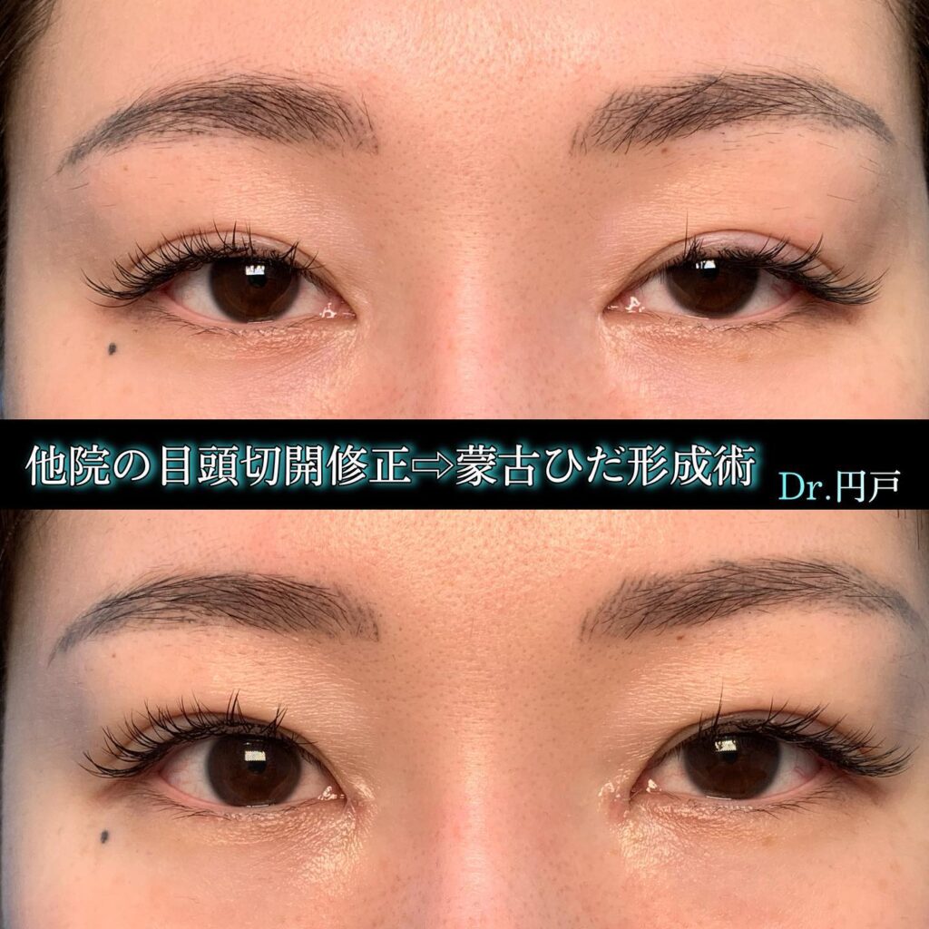 目元の他院修正