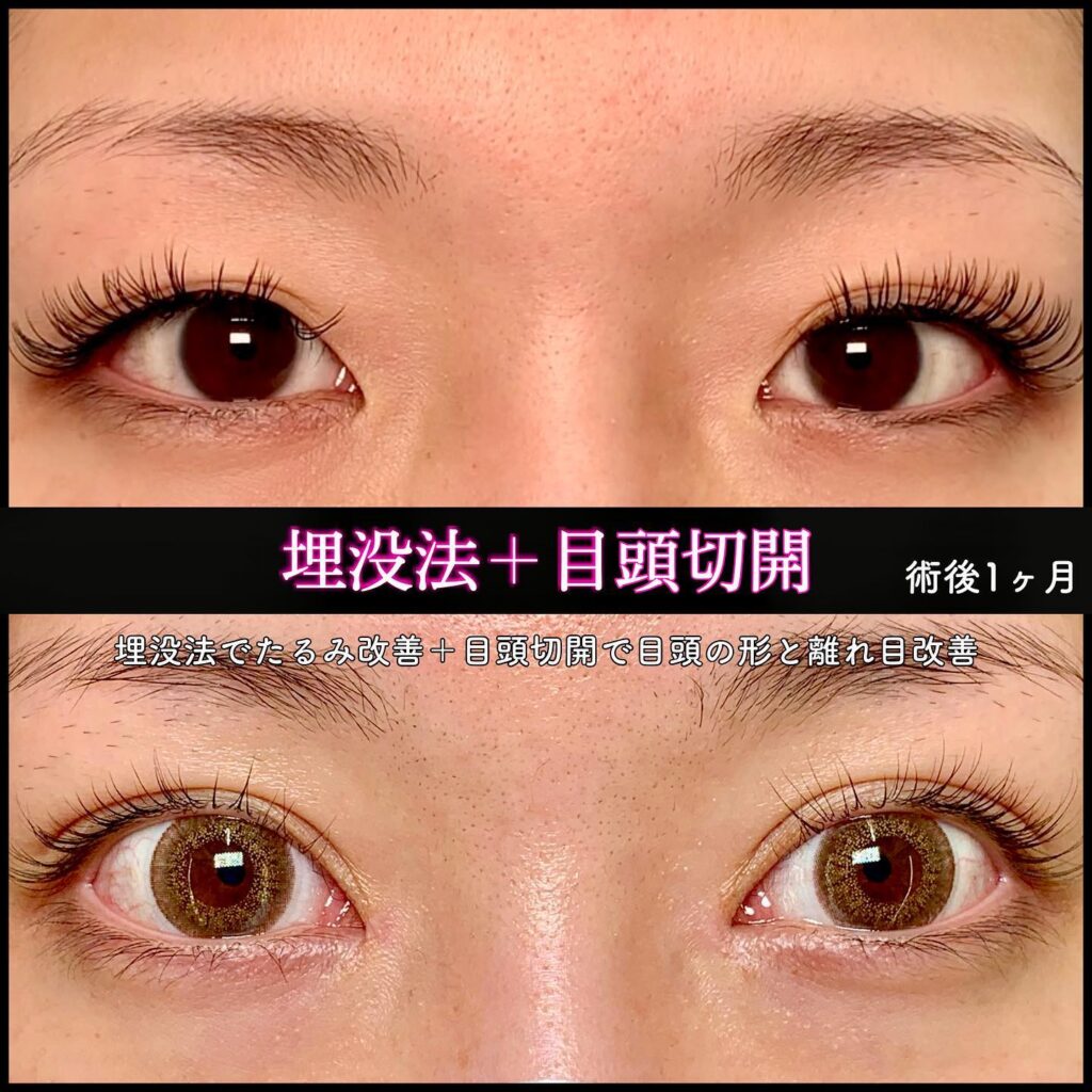 埋没法と目頭切開の症例写真 (2)