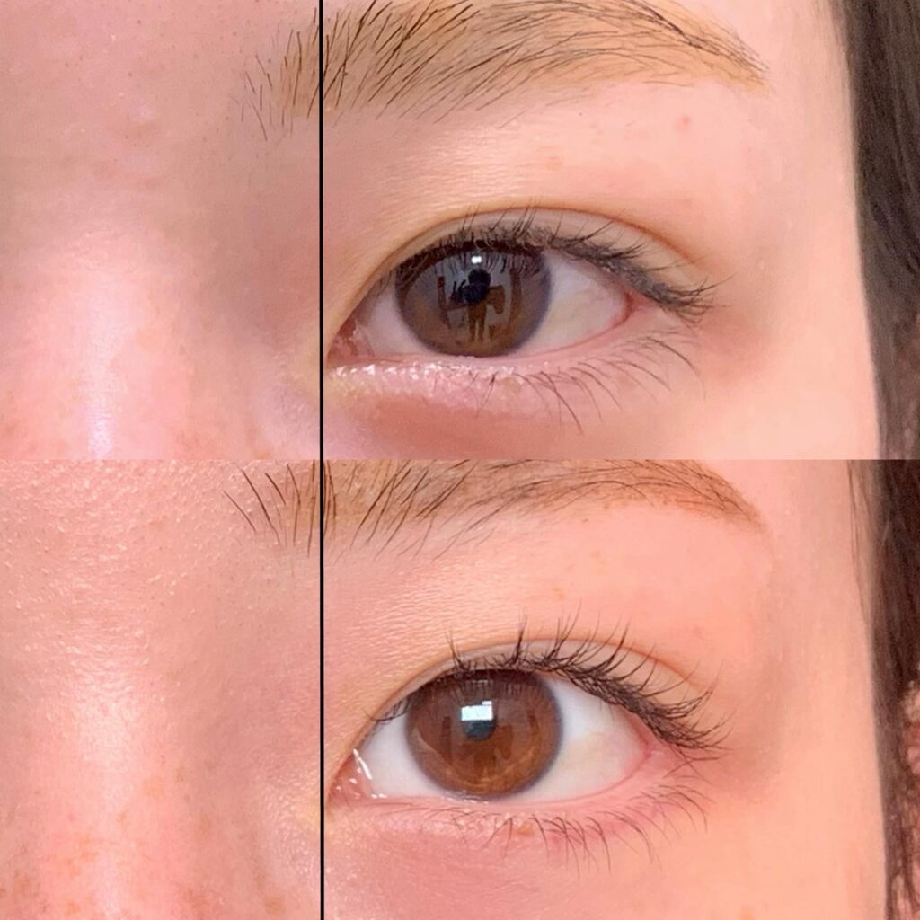 タレ目形成と目尻切開の症例写真 (4)