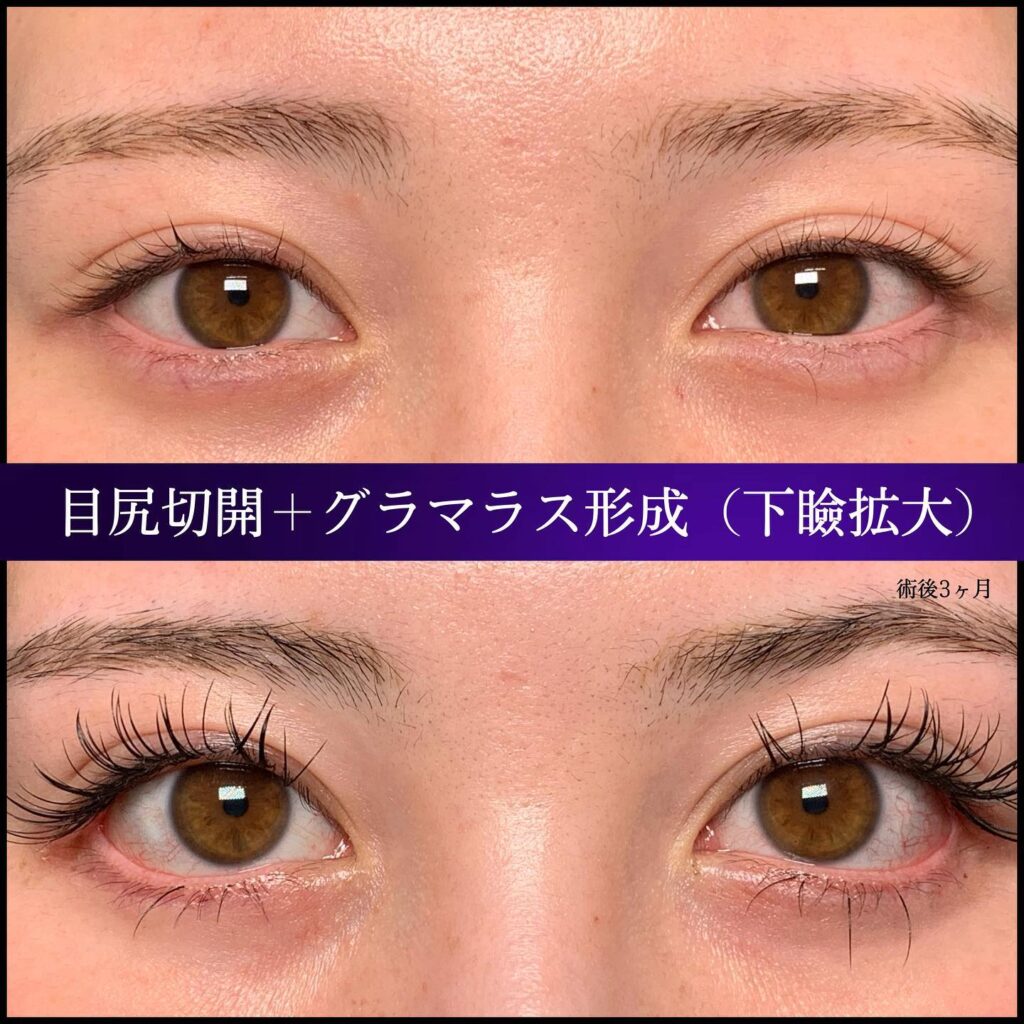 目尻切開とタレ目形成の症例写真 (7)