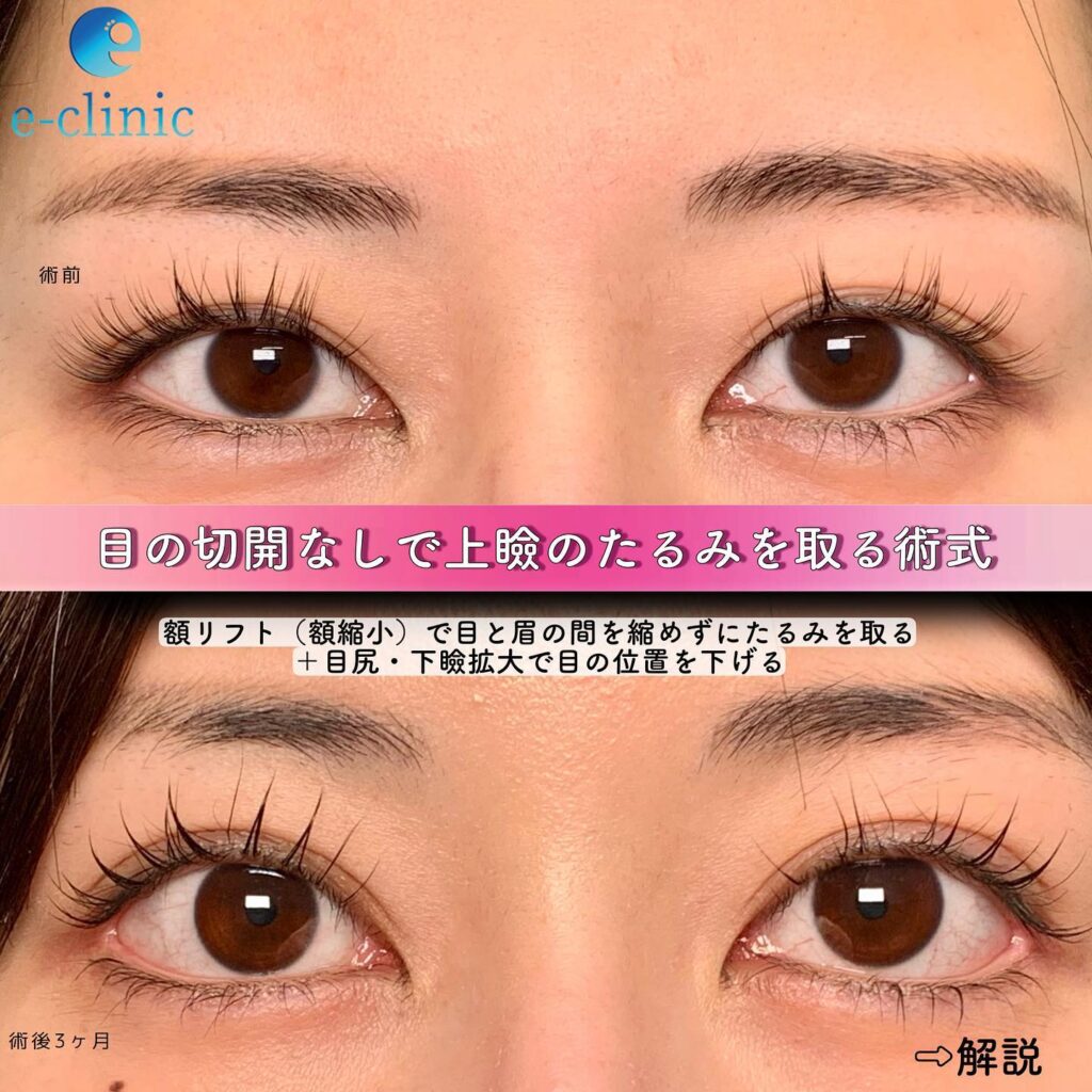 額リフトの症例写真 (1)