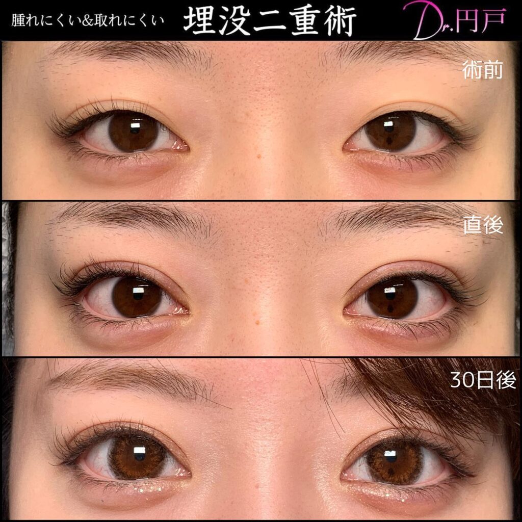 埋没法の症例写真 (13)