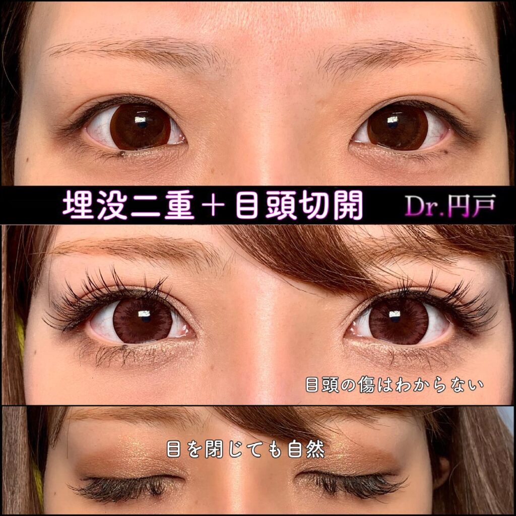 埋没法と目頭切開の症例写真