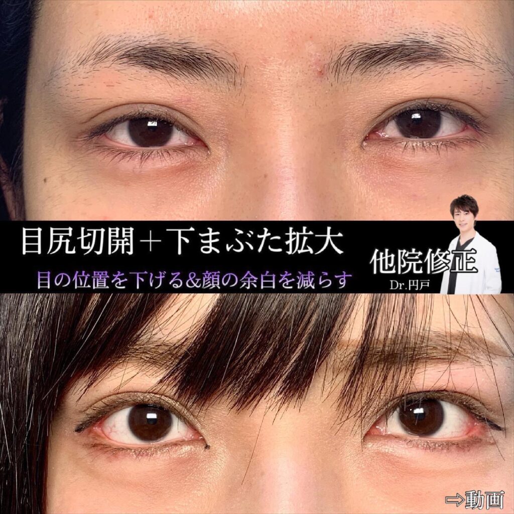 目尻切開とタレ目形成の症例写真