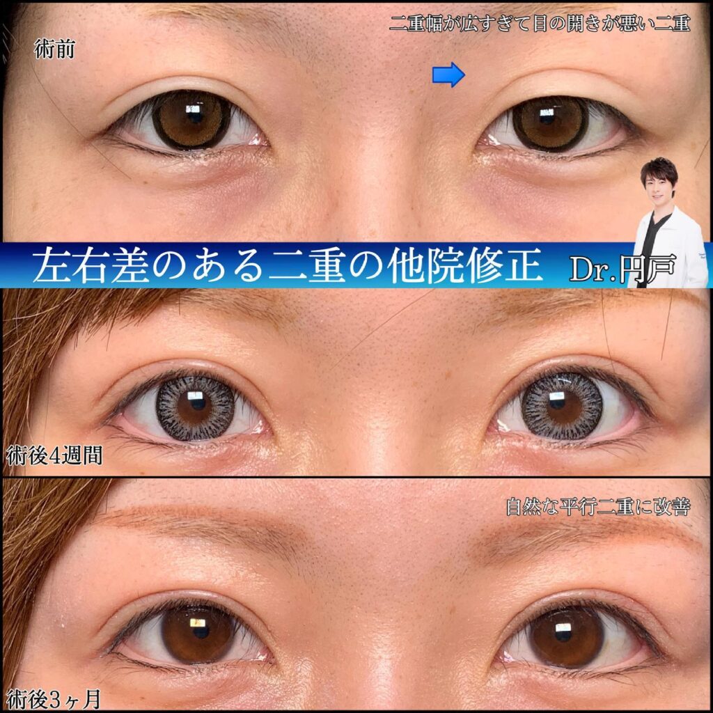 目元の他院修正 (3)