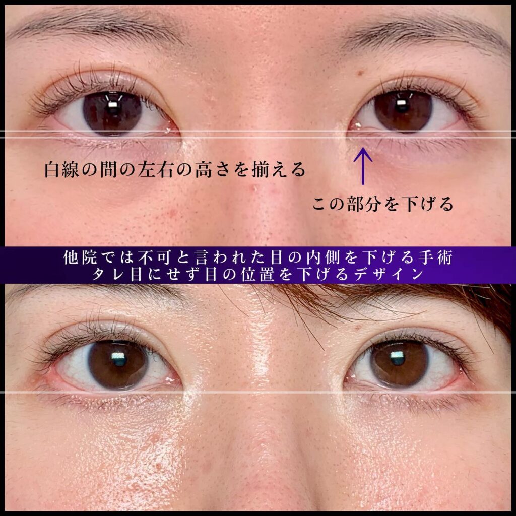 下瞼拡大と目尻靭帯移動の症例写真 (3)