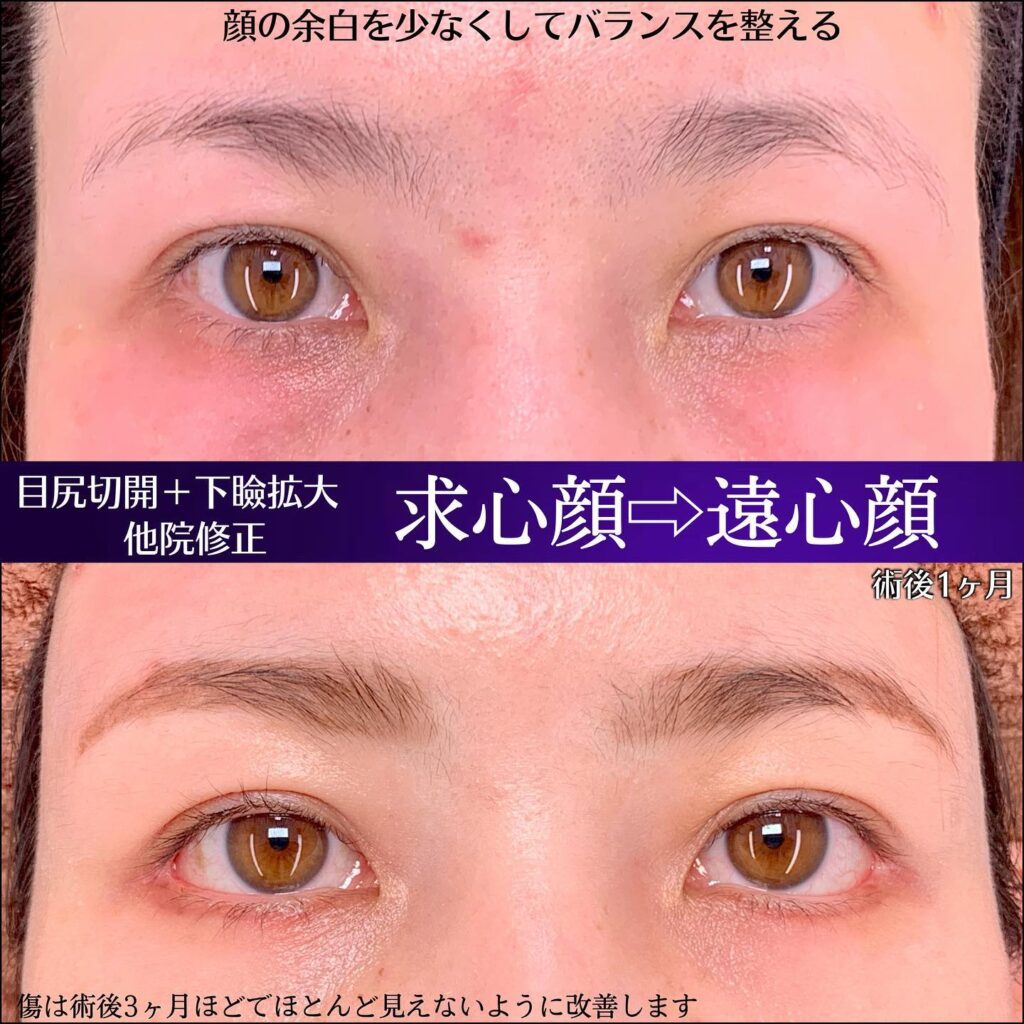 目元の他院修正と目尻切開とタレ目形成の症例写真