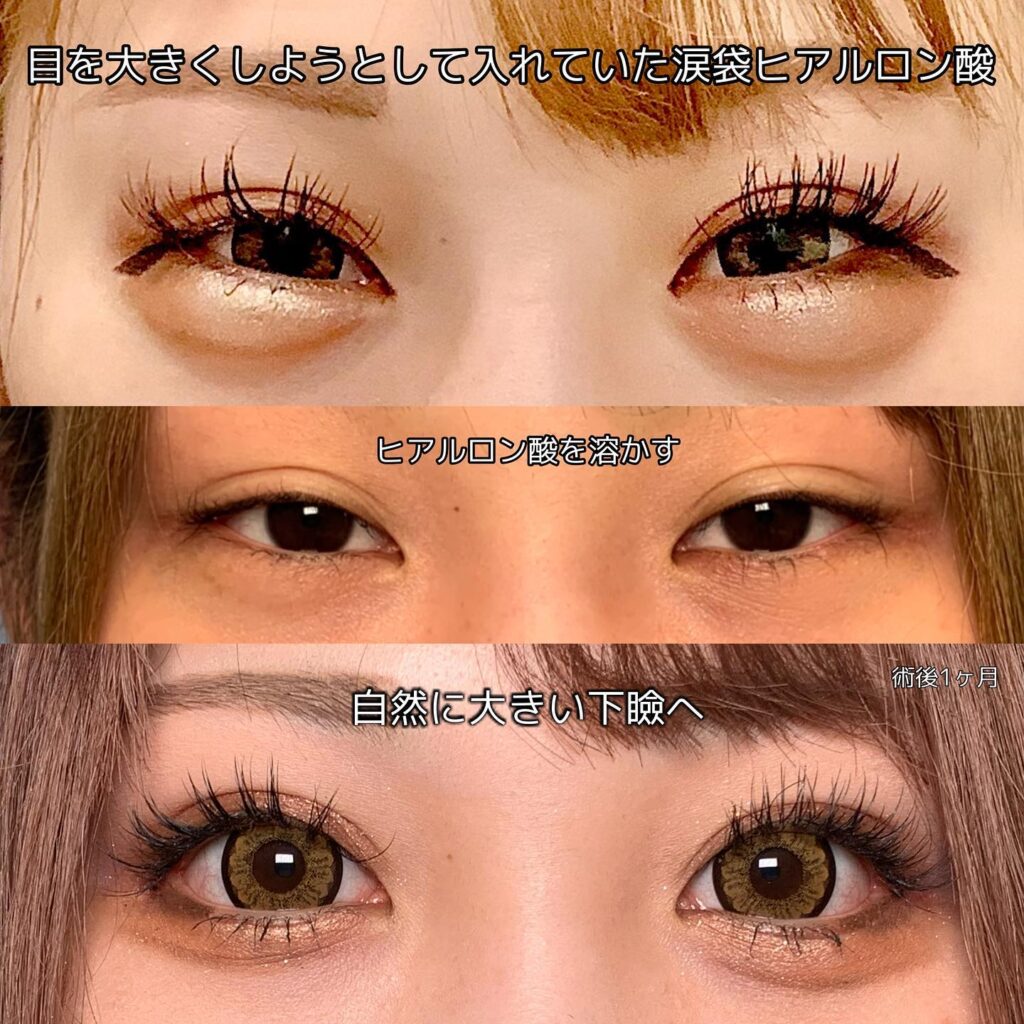 タレ目形成の症例写真