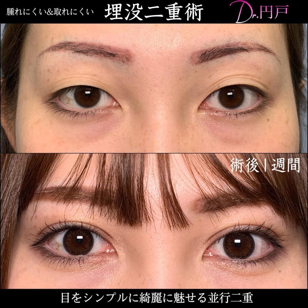 埋没法の症例写真 (23)