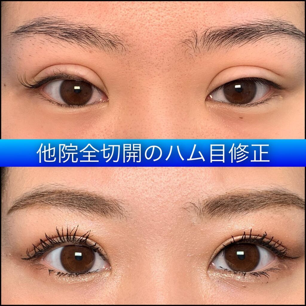 全切開の他院修正の症例写真 (2)