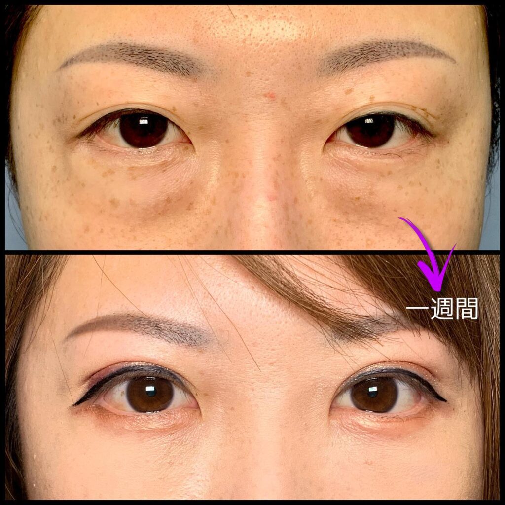 表ハムラの他院修正と脂肪注入と埋没法の症例写真 (2)