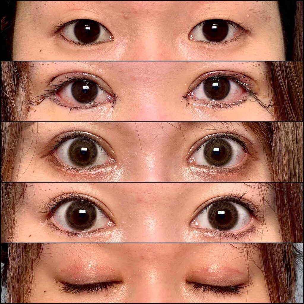 眼瞼下垂と全切開と目頭切開とタレ目形成と目尻切開の症例写真 (2)