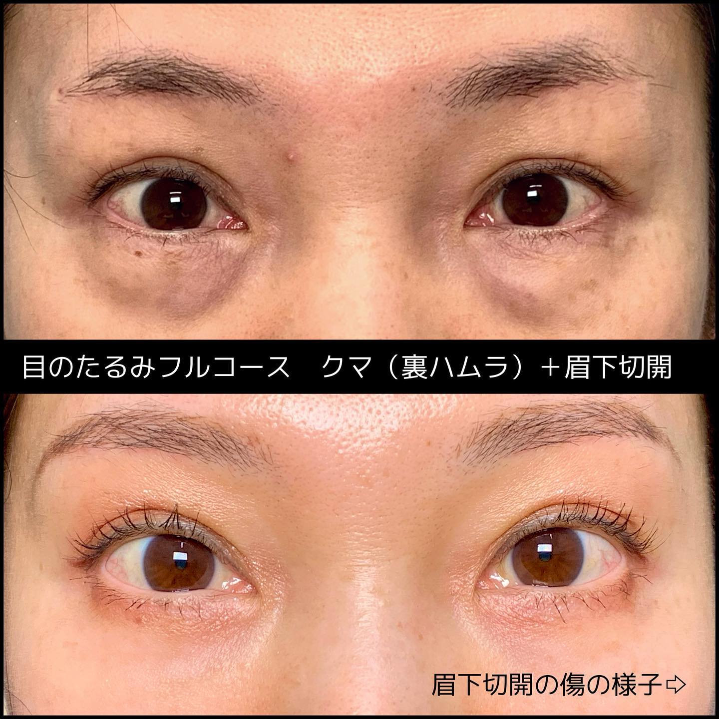 裏ハムラ法と眉下切開の症例写真 (2)