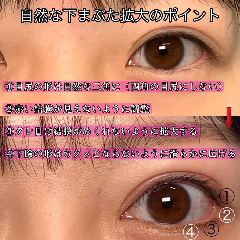 グラマラスライン形成と全切開と眼瞼下垂と目頭切開と目尻切開