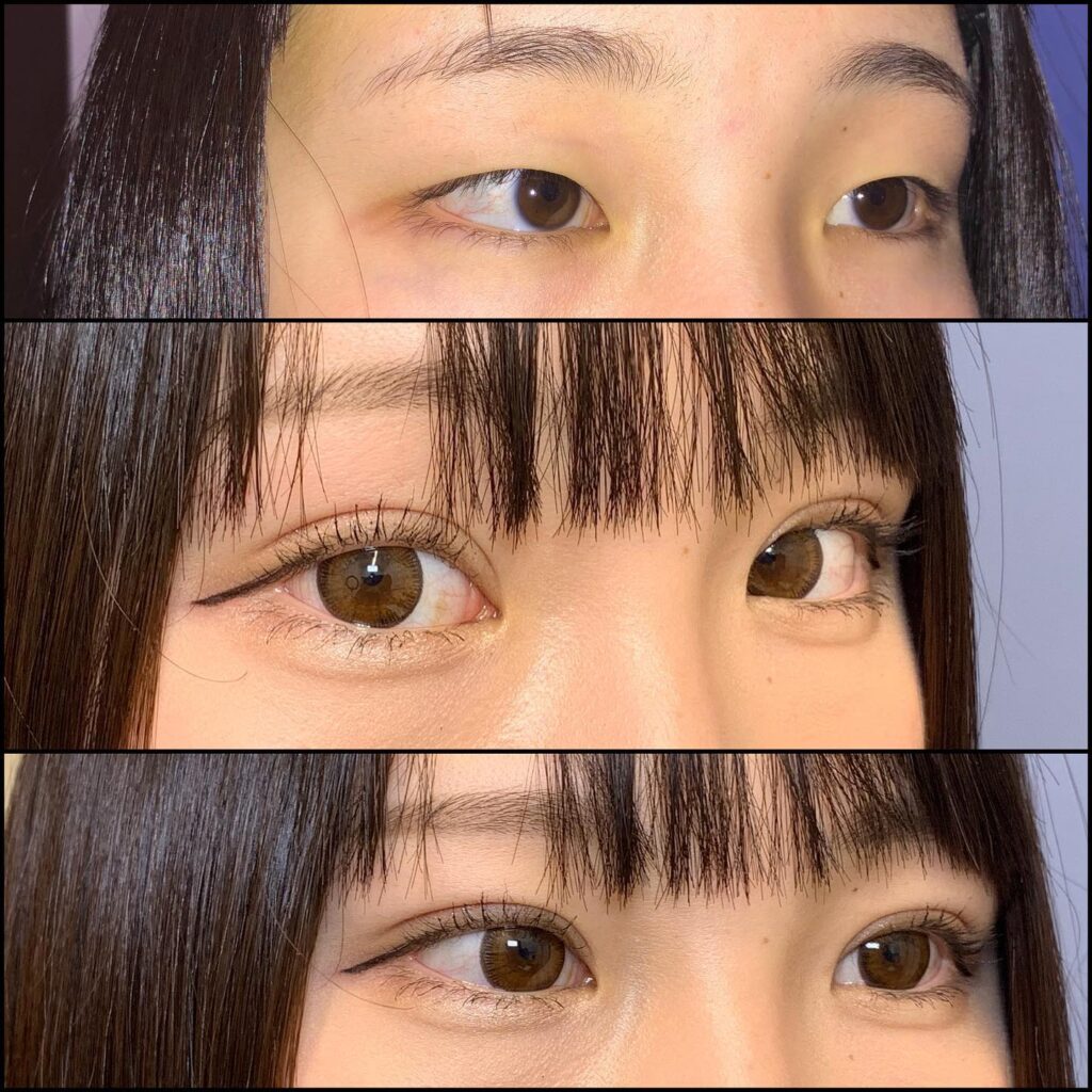 埋没法の症例写真 (28)