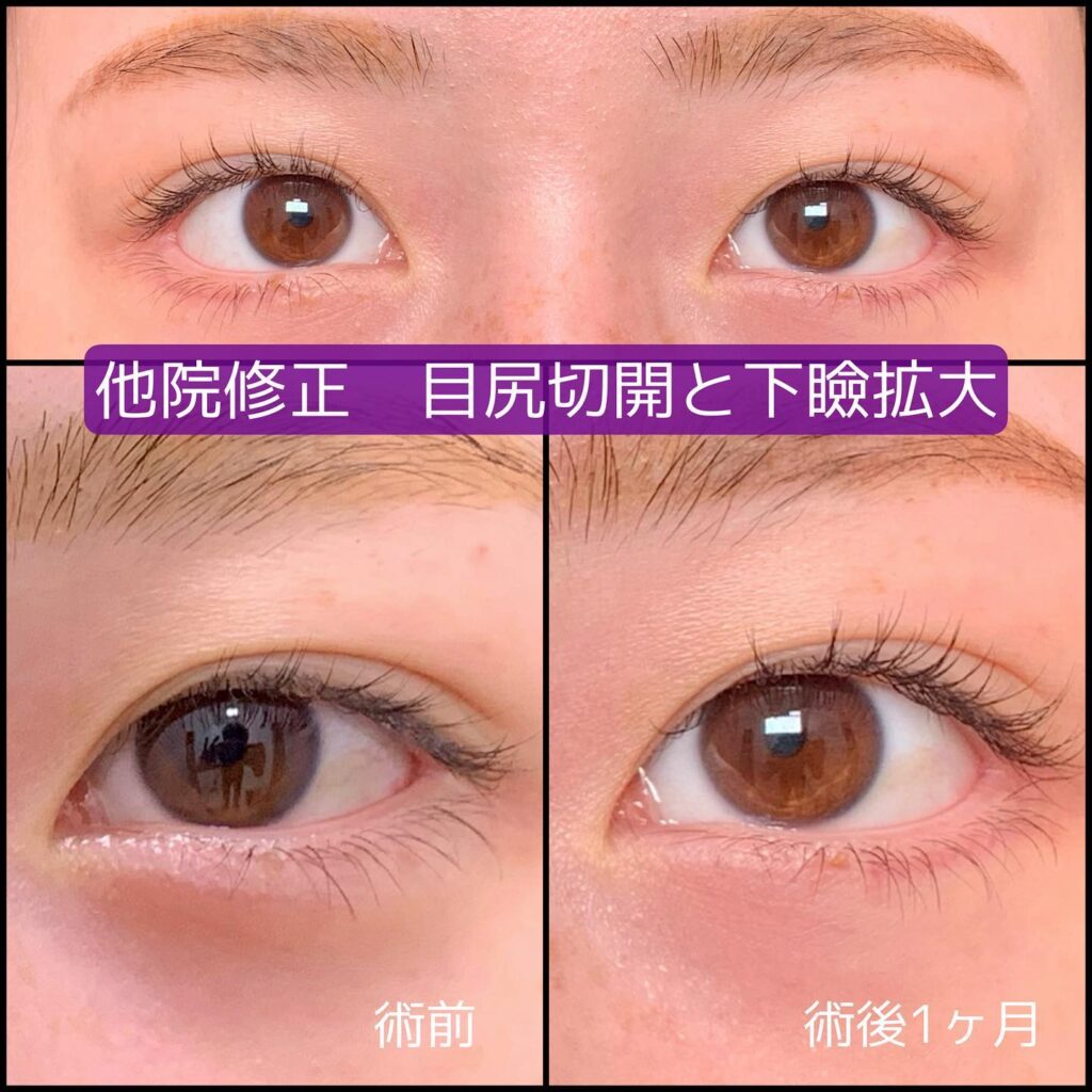 タレ目形成と目尻切開の症例写真 (1)