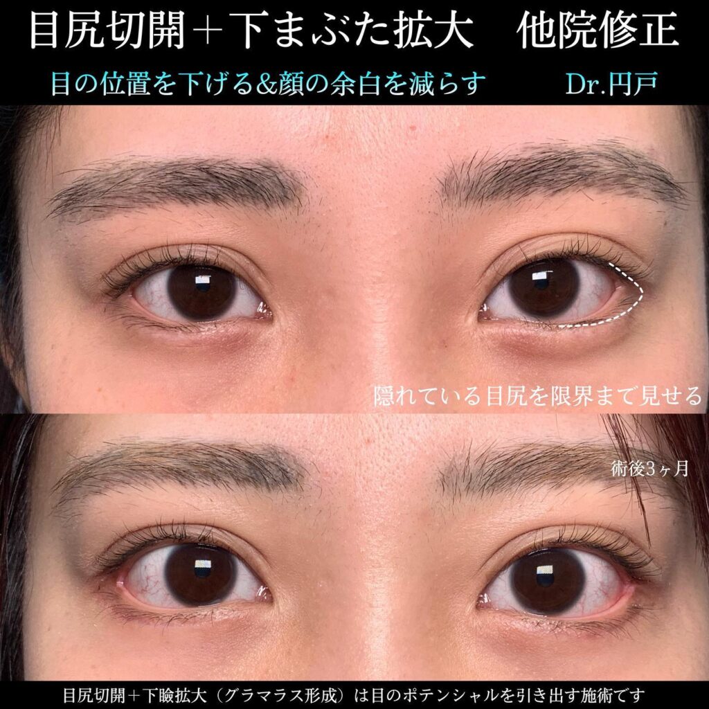 目尻切開とタレ目形成の他院修正の症例写真