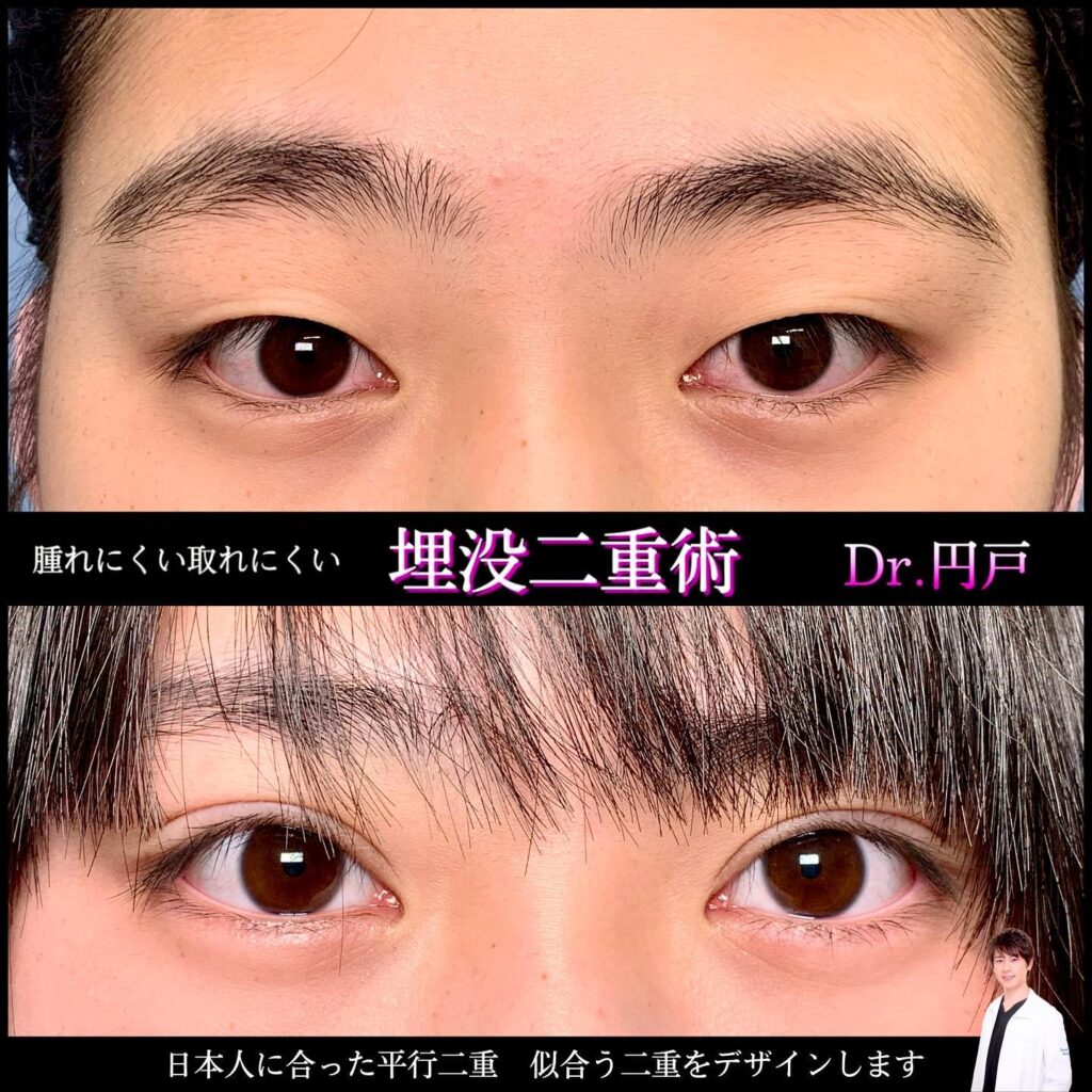 埋没法の症例写真 (17)