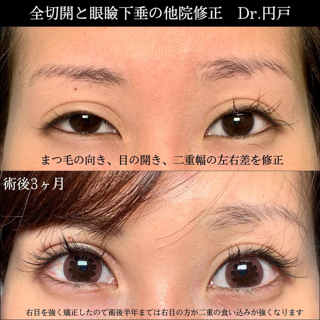 全切開と眼瞼下垂の症例写真