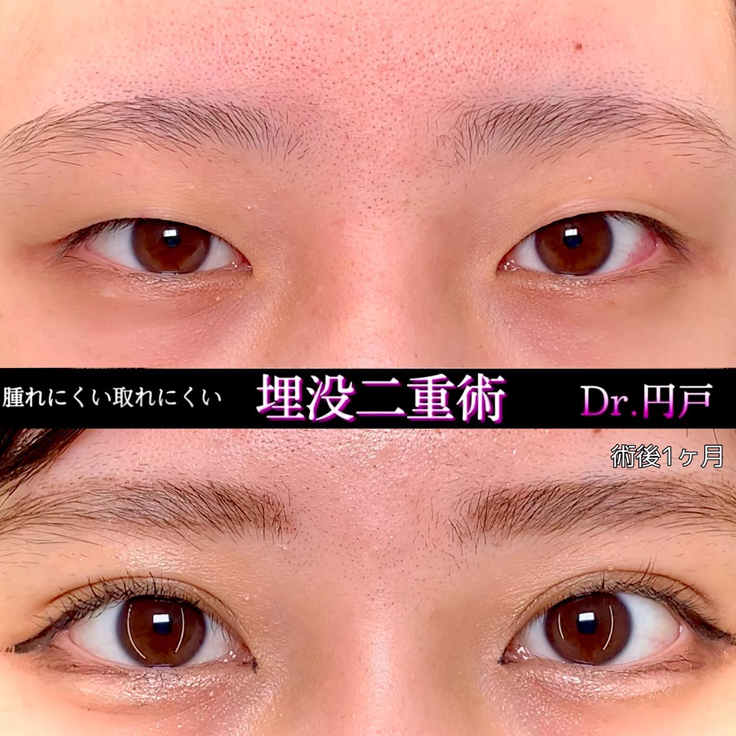 埋没法の症例写真 (22)