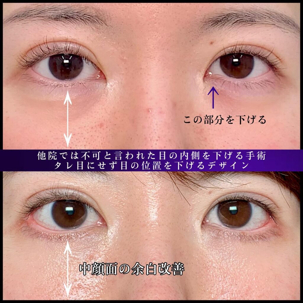 下瞼拡大と目尻靭帯移動の症例写真 (1)