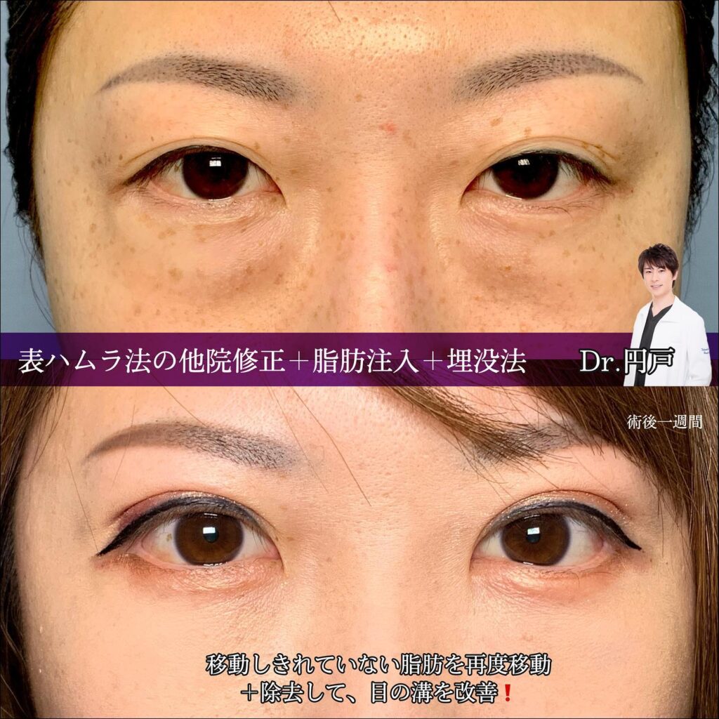 表ハムラの他院修正と脂肪注入と埋没法の症例写真 (1)