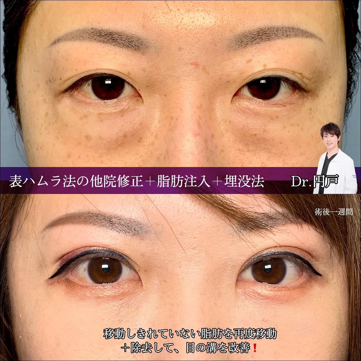 表ハムラの他院修正と脂肪注入と埋没法の症例写真 (1)