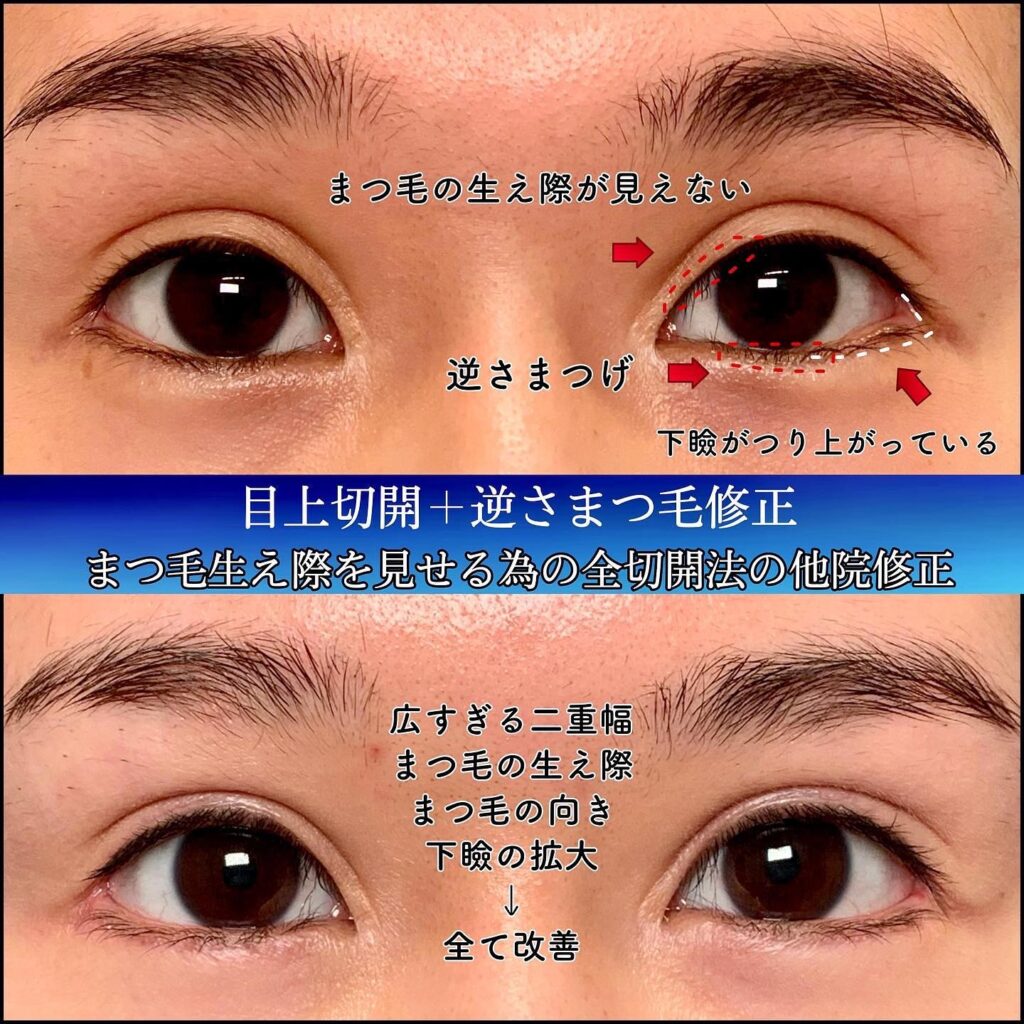 全切開の他院修正 (2)