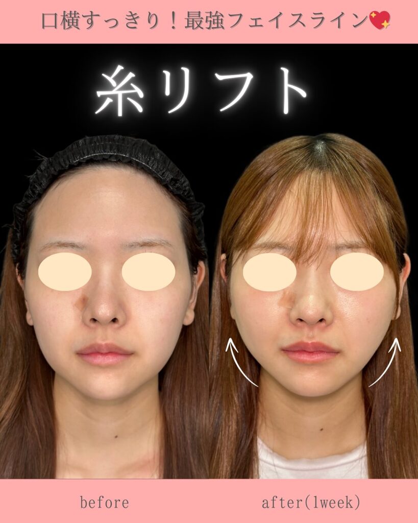 糸リフトの症例写真 (25)