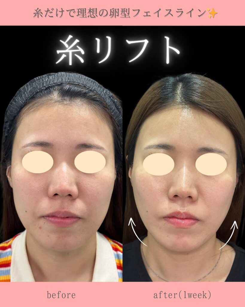 糸リフトの症例写真 (24)