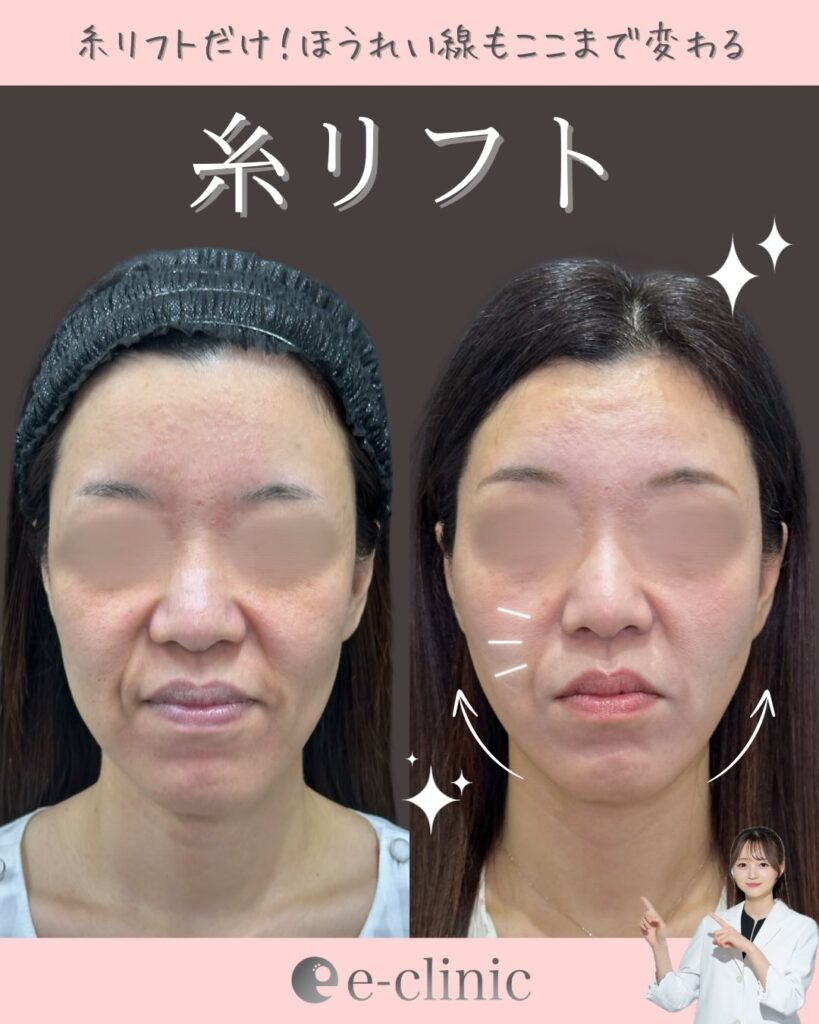 糸リフトの症例写真 (28)