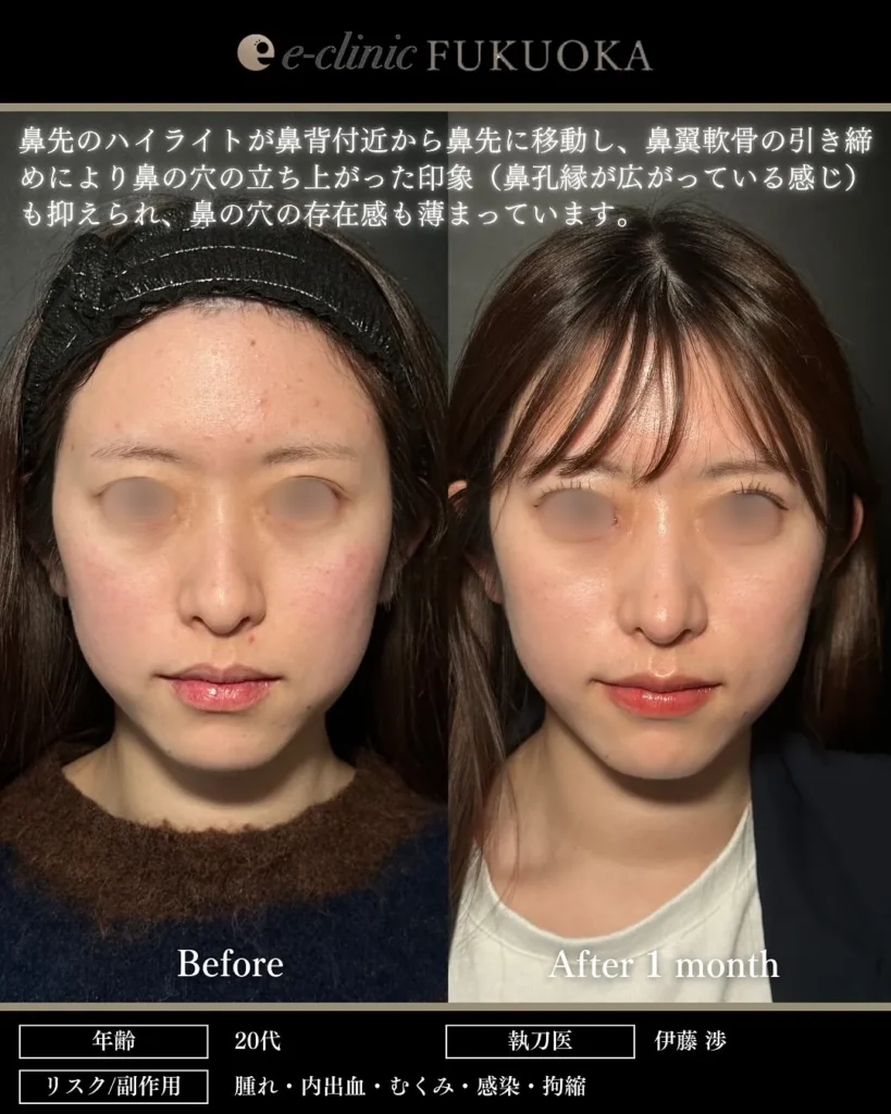 鼻整形（鼻フル）鼻尖形成と軟骨移植の症例写真（名医のeクリニック伊藤渉医師が執刀）