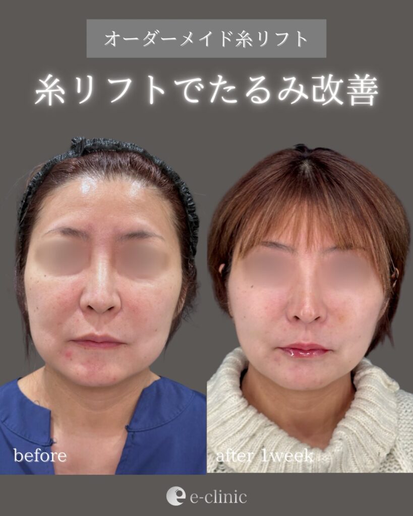 糸リフトの症例写真 (31)