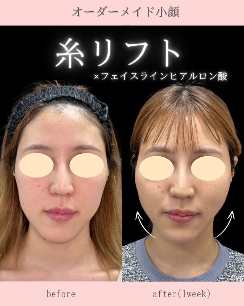 糸リフトの症例写真 (26)