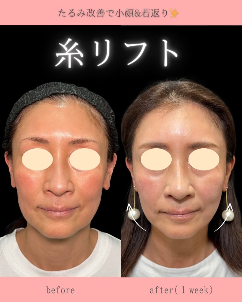 糸リフトの症例写真 (22)