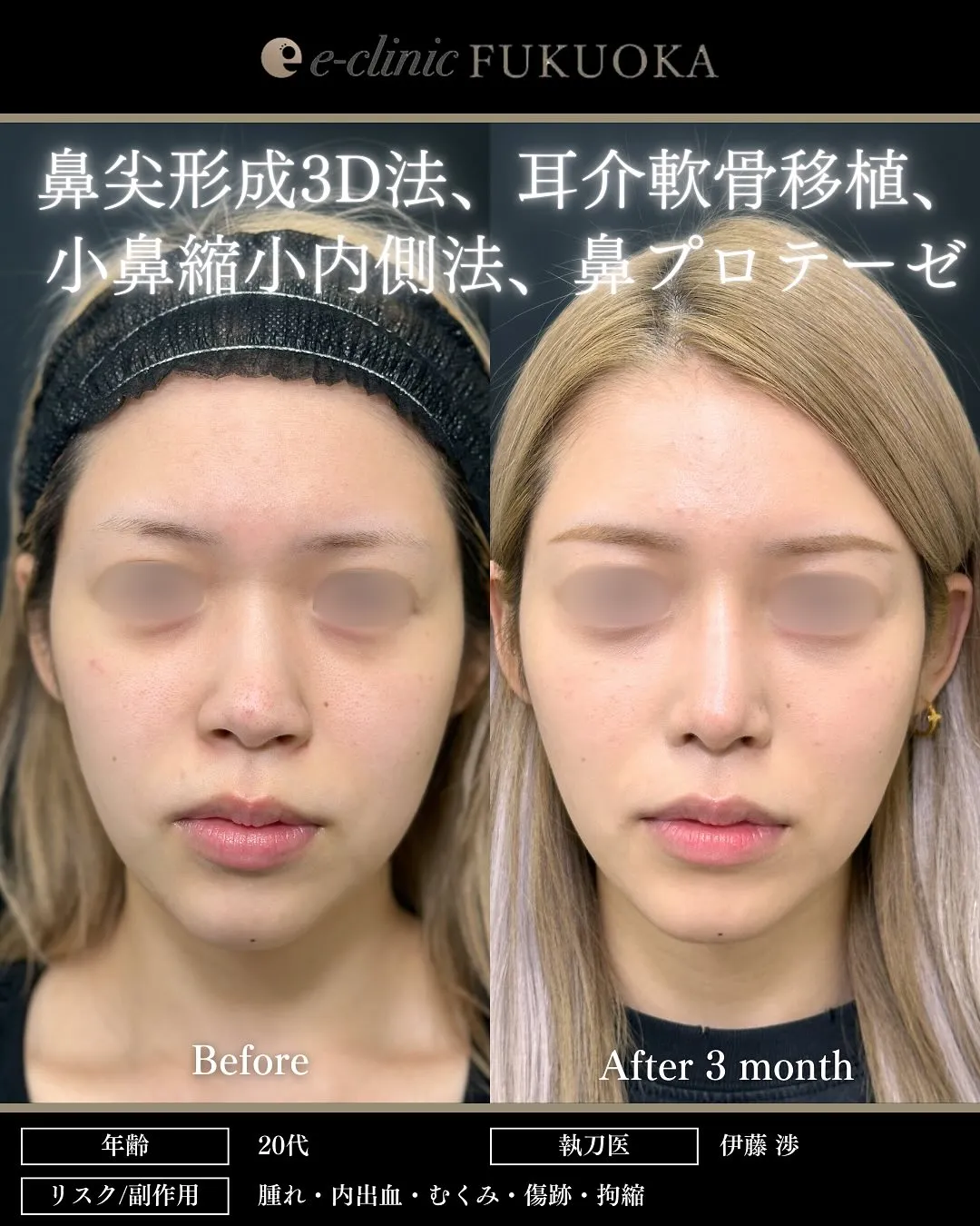 鼻整形（鼻フル）鼻尖形成と軟骨移植と小鼻縮小とプロテーゼの症例写真（名医のeクリニック伊藤渉医師が執刀）