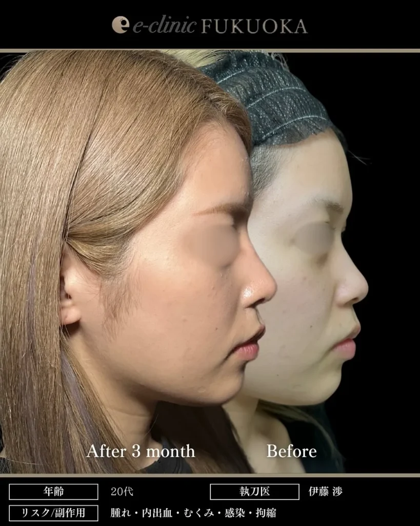 鼻整形（鼻フル）鼻尖形成と軟骨移植と小鼻縮小とプロテーゼの症例写真（名医のeクリニック伊藤渉医師が執刀）