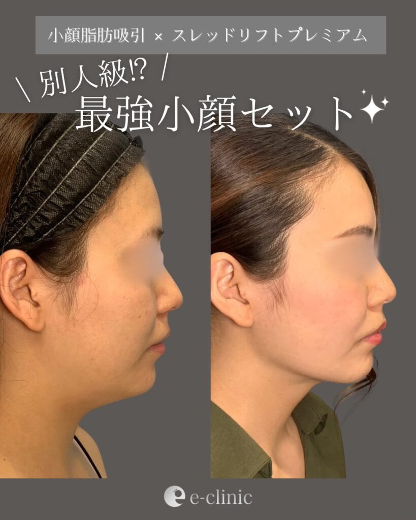 小顔脂肪吸引と糸リフトの症例写真