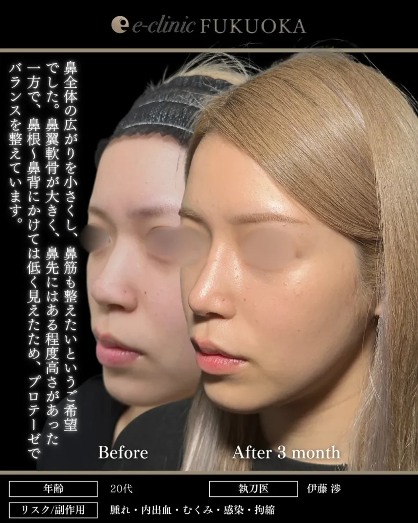 鼻整形（鼻フル）鼻尖形成と軟骨移植と小鼻縮小とプロテーゼの症例写真（名医のeクリニック伊藤渉医師が執刀）