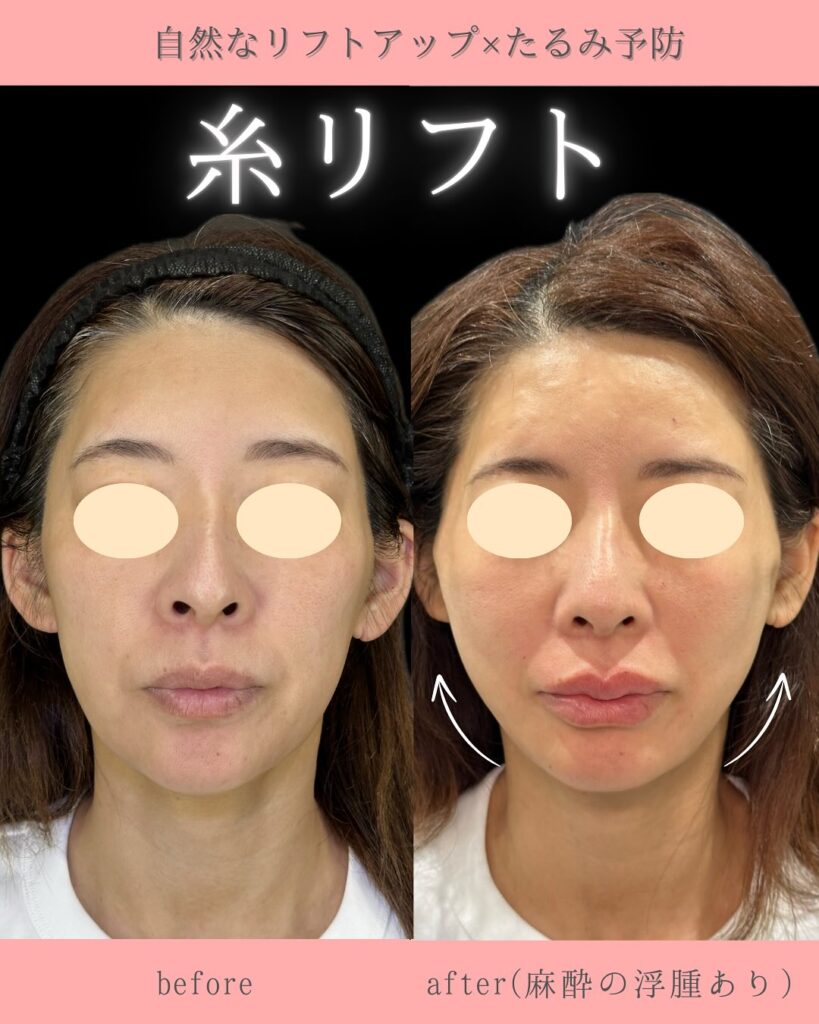 糸リフトの症例写真 (23)